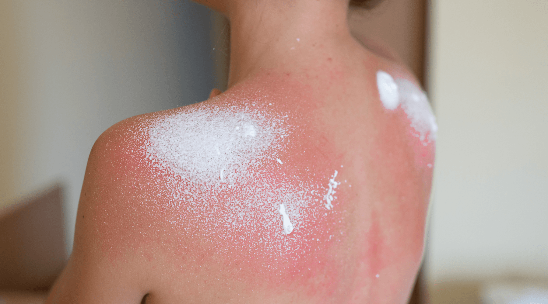 Back To Basics: The Patch Test (Sunscreen Tips for Sensitive Skin)