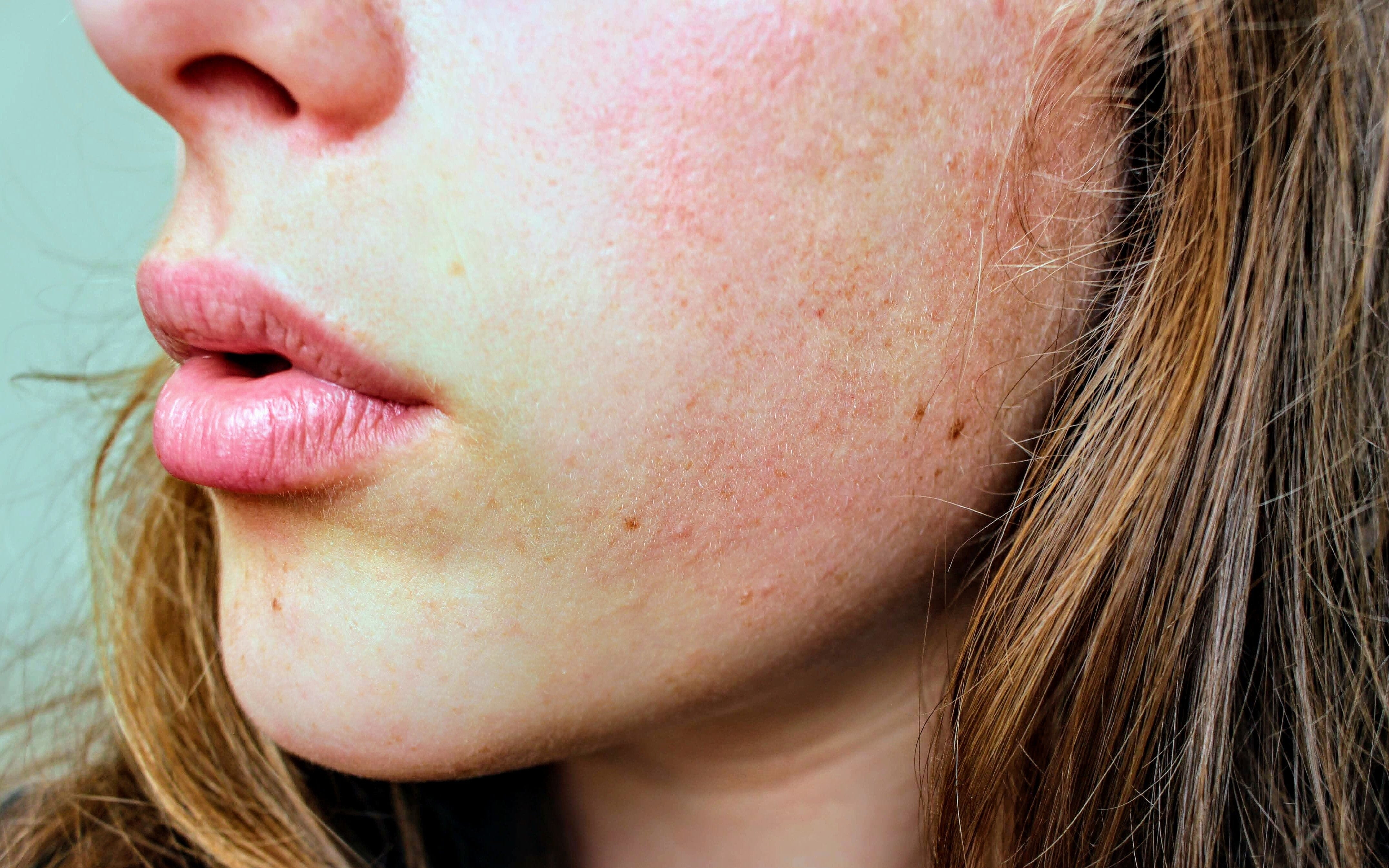Preventing Winter Dry Skin: How to Keep Skin Moisturized